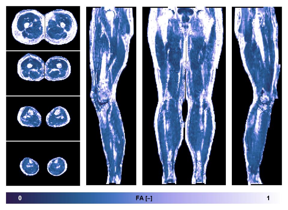 IVIM corrected whole leg muscle fractional anisotropy obtained from diffusion tensor imaging.